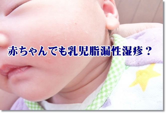 赤ちゃんでも乳児脂漏性湿疹？原因は？予防は？