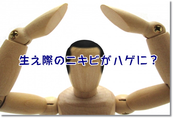 生え際のニキビが原因でハゲに？脂漏性湿疹か？