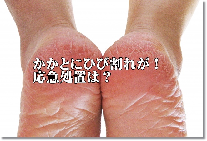 かかとにひび割れが！応急処置は？クリームを選ぶなら？