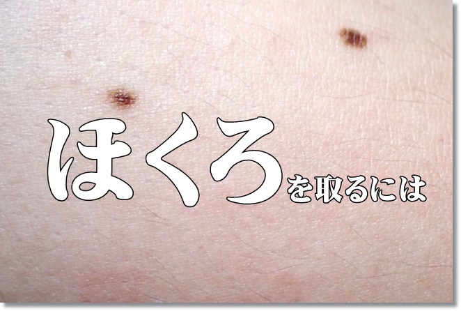 ほくろを取るにはカソーダ？もぐさ？ワートモールパニッシュ？