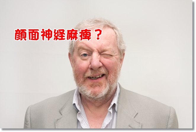 顔面神経麻痺の男性